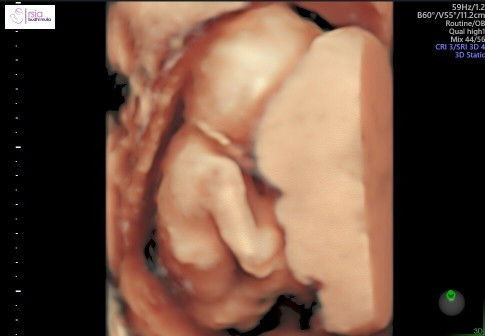 Plasenta ikut gerak janin kah?