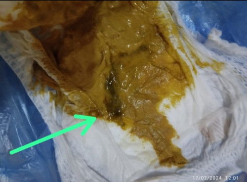 Dahak / reak pada bab bayi