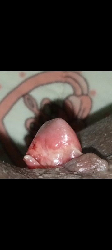 ริดสีดวงทำยังไงให้หายคะ