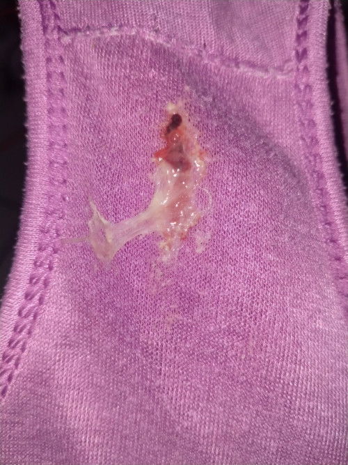 Keluar flek saat hamil 18week