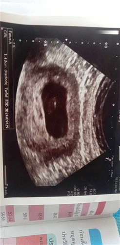 ไม่พบหารเต้นของหัวใจ