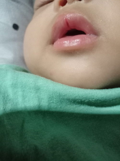 Sugat sa labi ni baby