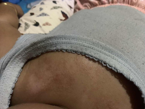 Kulit bayi 4 bulan merahmerah