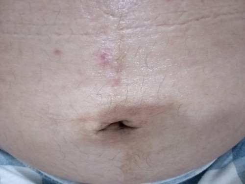 Bakit po sobrang makati ang pusod ko. 31weeks napo ako. Sana po may makasagot agad. Salamat