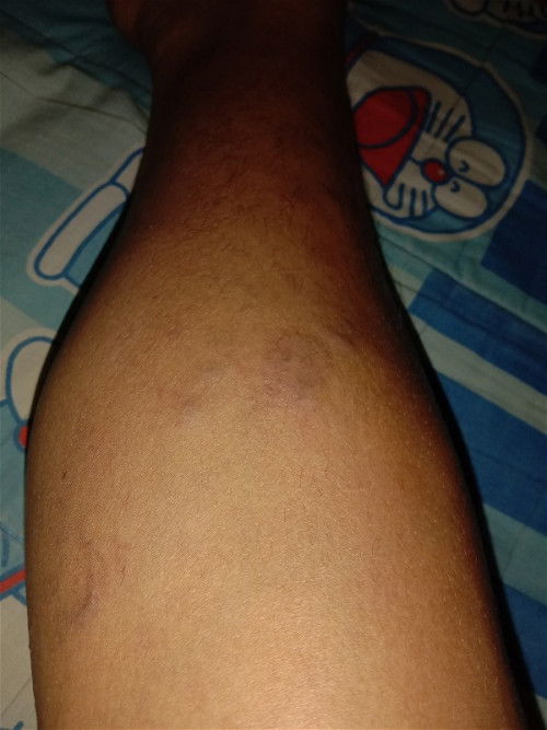 ขาเป็นรอยช้ำ