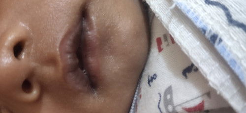 Bibir bayi 1 bulan berwarna hitam keunguan