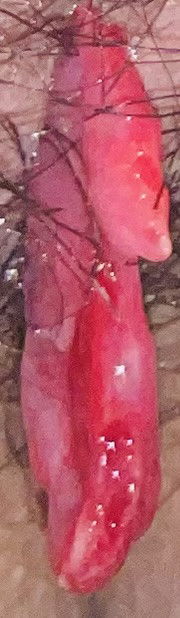 Polyp prolapse while pregnant 25 weeks (sensitive photo‼️)