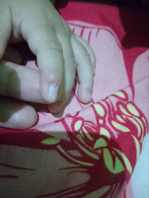 bentol merah di jari telunjuk