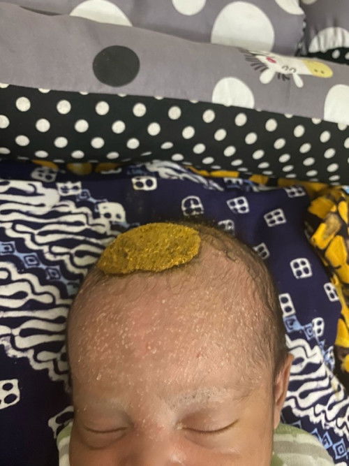 Muncul bruntusan di newborn