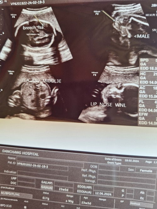 แม่ตัวเล็กมากๆกลัวน้ำหนักลูกต่ำกว่าเกณฑ์