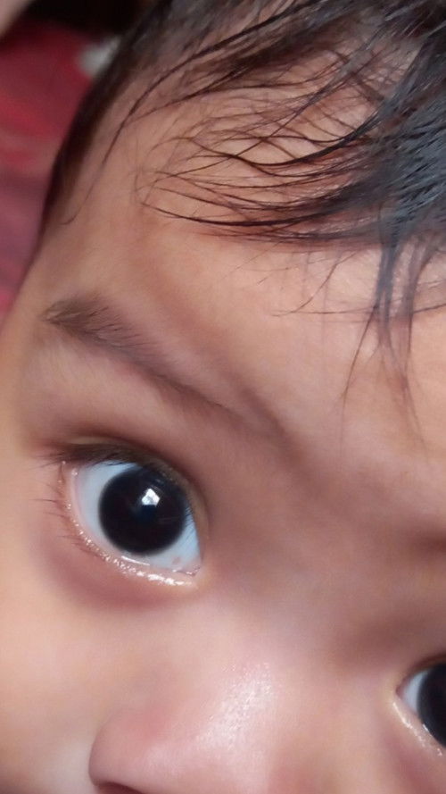 Mata berdarah atau bkn