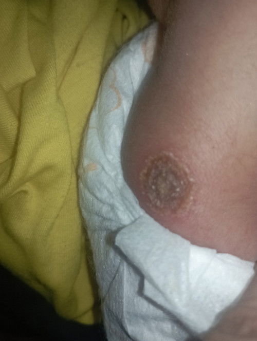 bekas imunisasi/vaksin