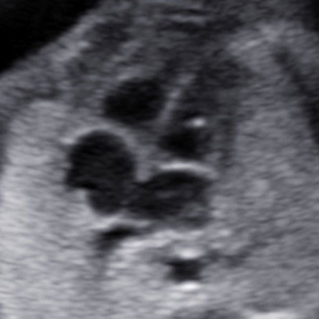 Dot putih di jantung