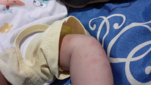 Gatal pada tangan bayi