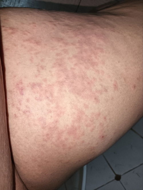 ผื่นคัน แบบนี้อันตรายมั้ยค่ะ