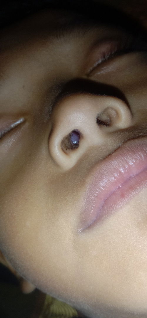 benjolan didalam hidung