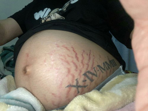 ครีมรักษรอยแตกแดง