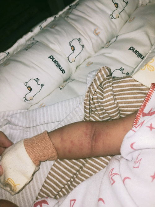 Bayi 20 hari tangan kaki badan merah2 gini kenapa ya bun, tlg saran nya🥹