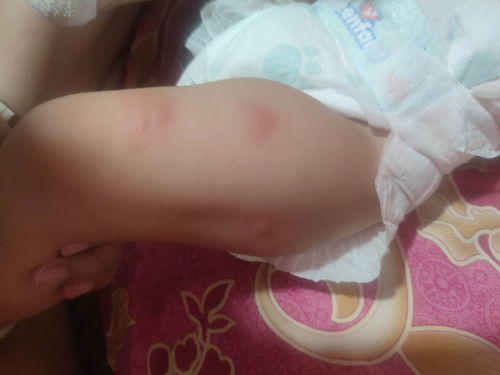 Effective bug repellant for baby? Pati mabilis na pamalis ng scar and dark marks due to insect bites