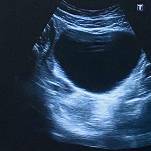 อายุครรภ์ 5w4d ซาวด์ครั้งแรก