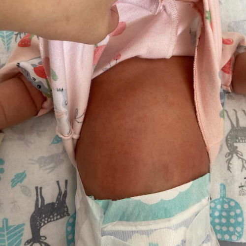 bintik merah pada bayi 20hari