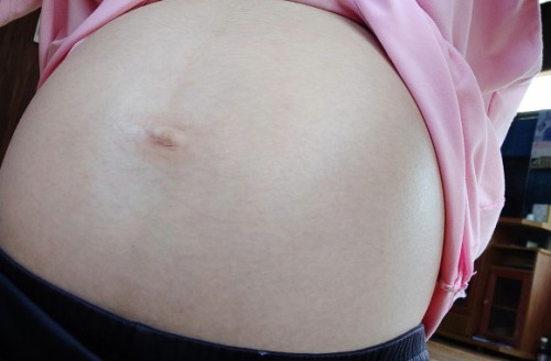 ตอนนท้องงไม่แตกลายย หลังคลอดดมีสิทธิ์แตกมั้ยยยคะ