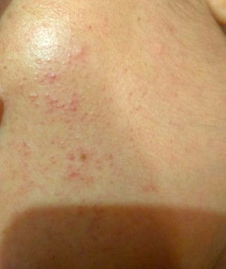 Bintik merah diwajah