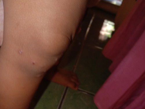 Bintik merah dan bernanah