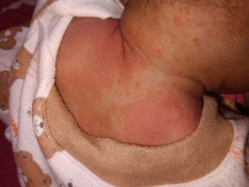 Biang keringat atau alergi ya?