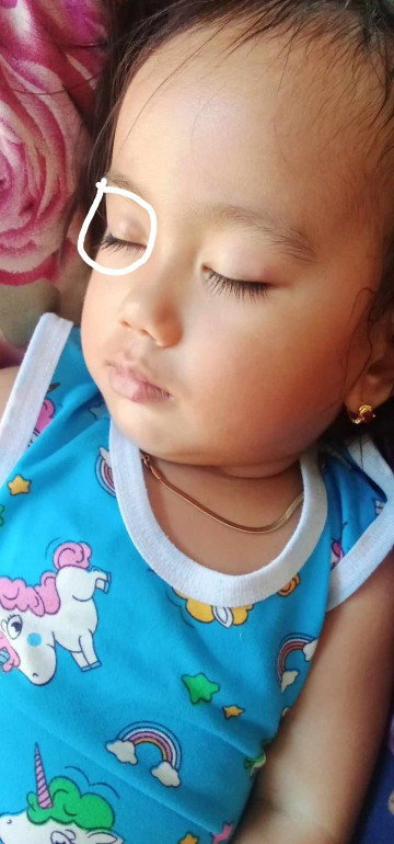 May bukol sa mata ng baby ko pag nakapikit sya dun makikita may bukol pag nakadilat dinsya halata