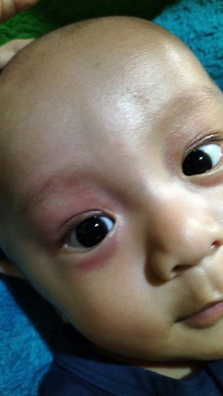 Ada yang tau penyebab dan obatnya gak Bun? Tp kayaknya gak gatel deh Krena gak dikucek2 sama baby