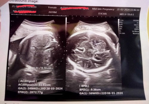 Usia BPD lebih 3mingu dari GA