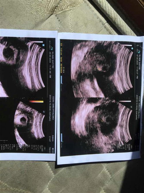 5-6w Hanya terlihat kantung kehamilan saja