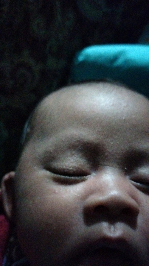 Kulit bruntus pada wajah bayi