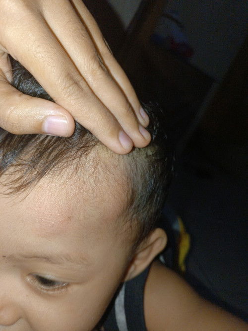 Benjolan di kepala anak