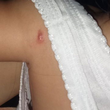 Ada bentol pada kulit bayi tapi tidak kunjung hilang