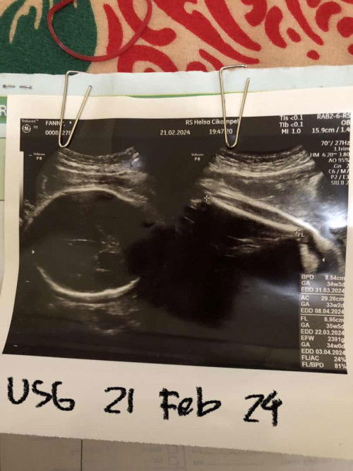 Pengapuran di 35 minggu