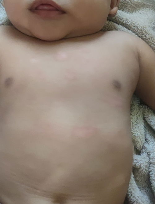 Merah merah di badan