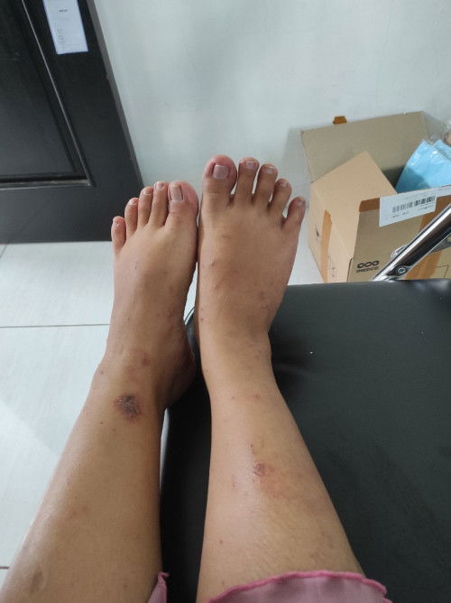 Gatal gatal di area kaki tangan