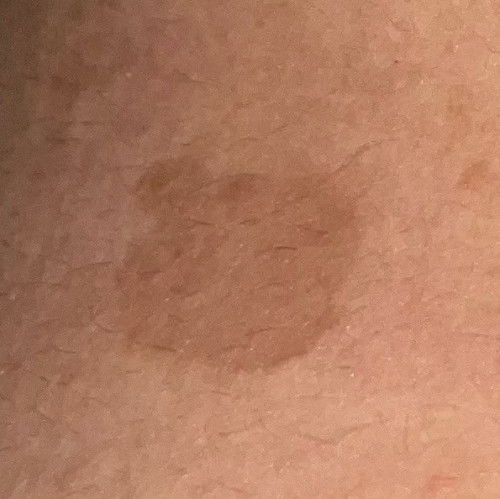 Bercak coklat di kulit