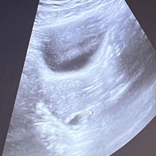 Hamil 8 Weeks terlihat kantung saja di bawah