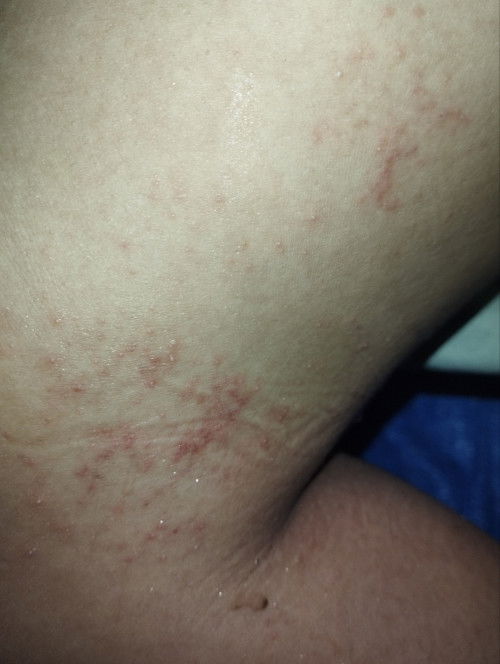 bun maaf mau tanya masuk tm 3, ada gak ya yang ngalamin kaya aku . bentol2 gatal seperti ini.