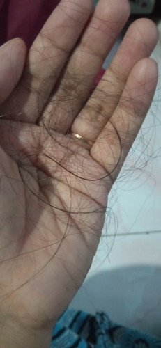 Rambut Rontok Parah