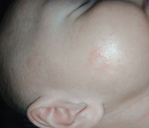 Rashes sa muka ni baby...