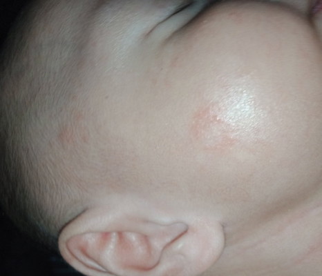 Rashes sa muka ni baby...
