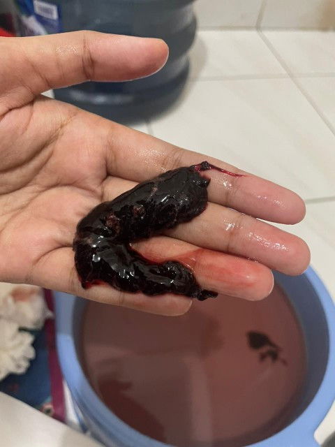 Pendarahan hebat keluar gumpalan