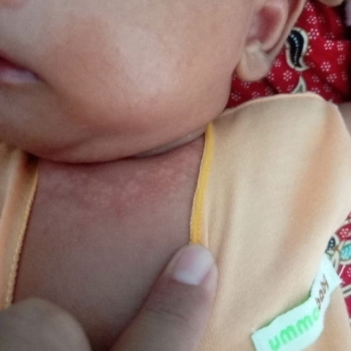 Berentusan d leher bayi