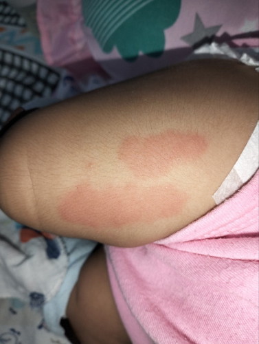 Mga mii namaga po ung paa n baby after ilang days matapos syang turokan ng dpt at pcv .