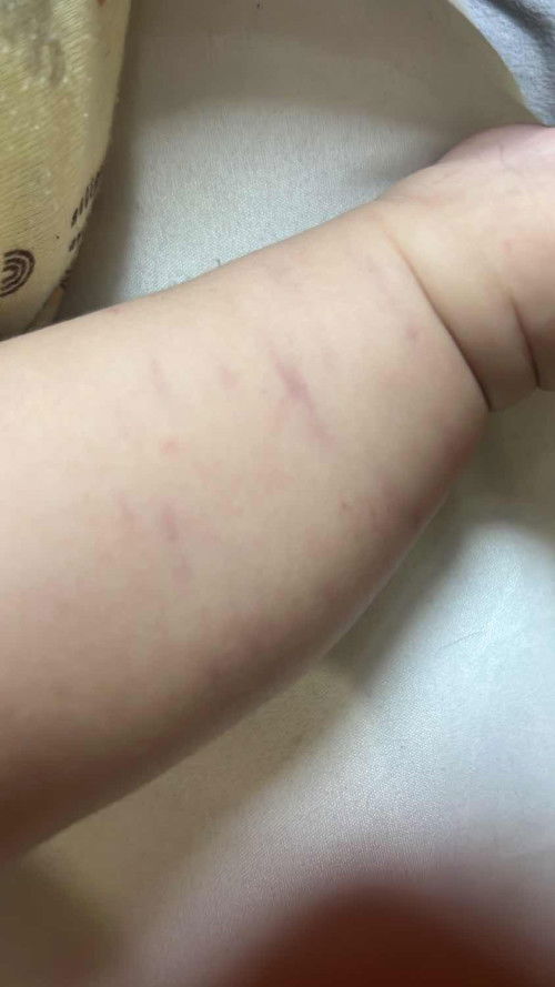 Memar di kaki bayi 3 bulan