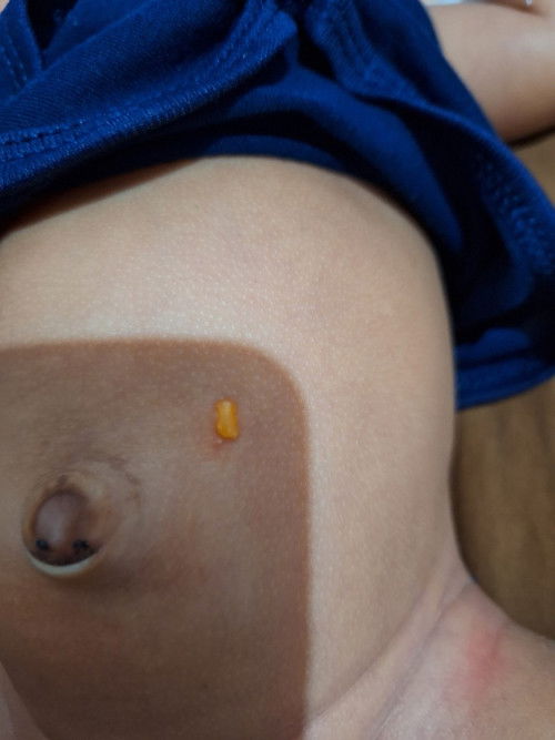 Muncul bintil berair warna kuning